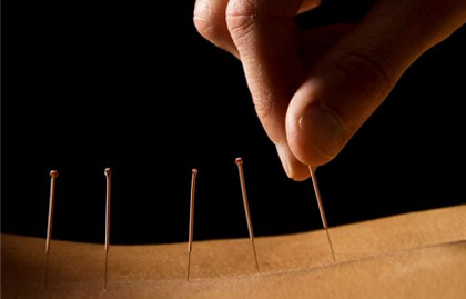 Acupuncture Needles