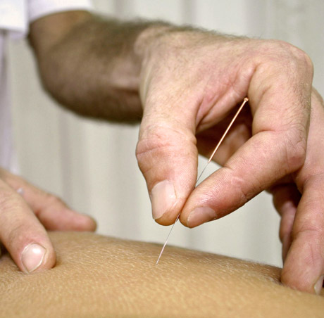 Treatment with Acupuncture